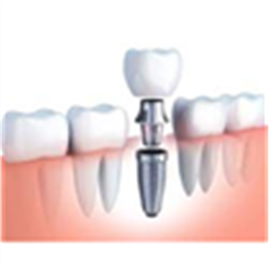Implants